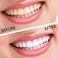 professional teeth whitening kit before and after